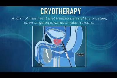 What is Cryotherapy? | Global Robotics Institute | AdventHealth