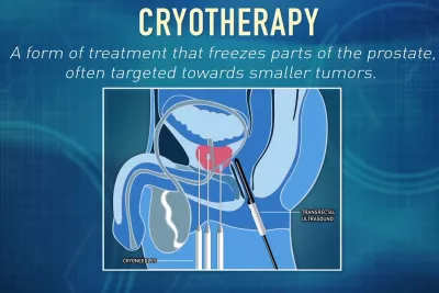 What is Cryotherapy? | Global Robotics Institute | AdventHealth
